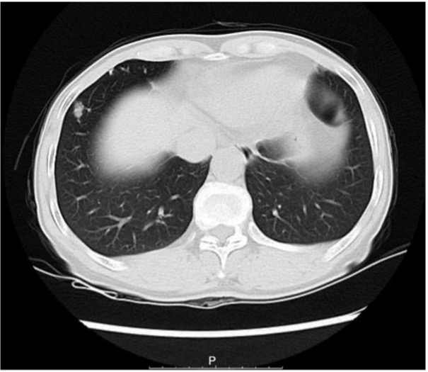 Figure 1 - CT scan of patient in case study 1, the bilateral thorax was symmetrical, and no obvious abnormalities were found. The trachea is centered, and the tracheobronchial tree is unobstructed. A solid nodule (thin layer lm373) was found in the lower lobe of the right lung, with a long diameter of approximately 11.3 mm. There are a few micronodules in both lungs. The structure of the bilateral lung hilum was clear, and there were no obvious abnormalities in shape, size, and position. There was no abnormal enlargement of lymph nodes in each group of mediastina.