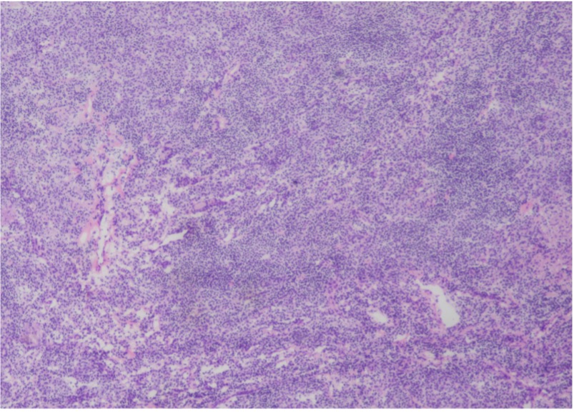 Figure 2 – H&E staining of tissue section from lower right lung, 120x40x15mm in size. Lymphoid tissue proliferation was seen in the sections, and no obvious malignant lesions were found under routine H&E staining.