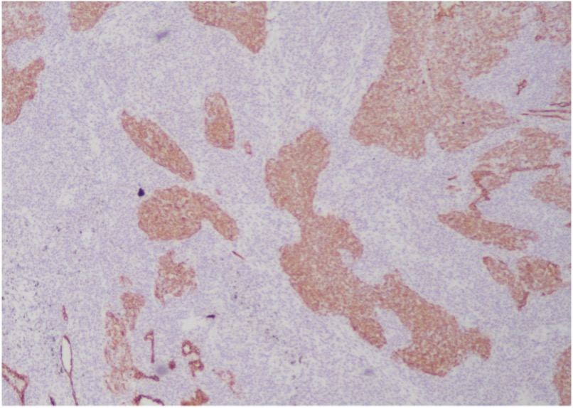 Figure 3 –Celnovte Biotechnology frozen section rapid IHC staining of tissue section from lower right lung, 120x40x15mm in size. After CK staining, small focal clusters of epithelial cells were seen in the sections, which was considered an epithelial malignant tumor.