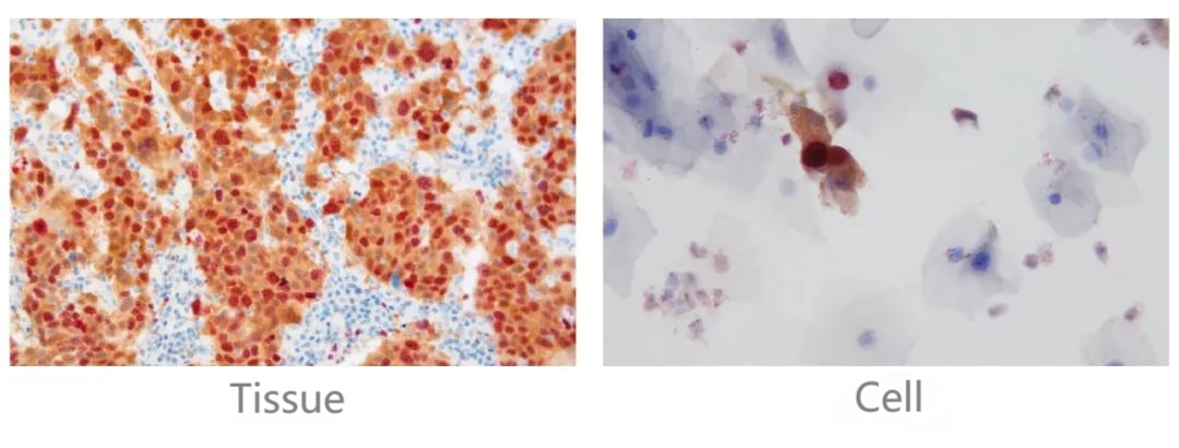 The P16/Ki-67 Dual Staining Detection Kit by Celnovte is a highly advanced diagnostic tool used for the detection of p16 and Ki67 biomarkers on cells or tissue samples.