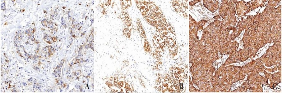 Currently, the expression of TROP2 protein is mainly detected using immunohistochemistry.