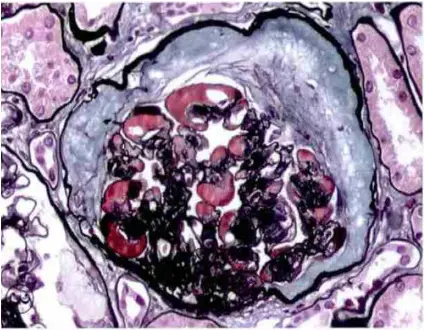 renal detection