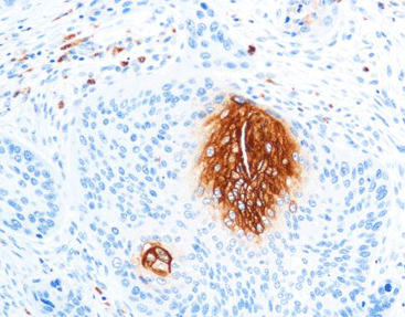 Carcinoembryonic Antigen(CEA)