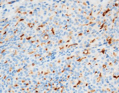 Prostate Specific Membrane Antigen (PSMA)