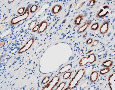 Renal Cell Carcinoma Marker(RCC)