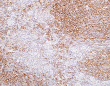 Human germinal center-associated lymphoma(HGAL)