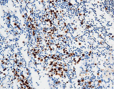 Multiple Myeloma Oncogene 1 (MUM-1)